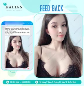 Phản hồi tích cực của khách hàng về dịch vụ thẩm mỹ nâng ngực tại Kalian 2