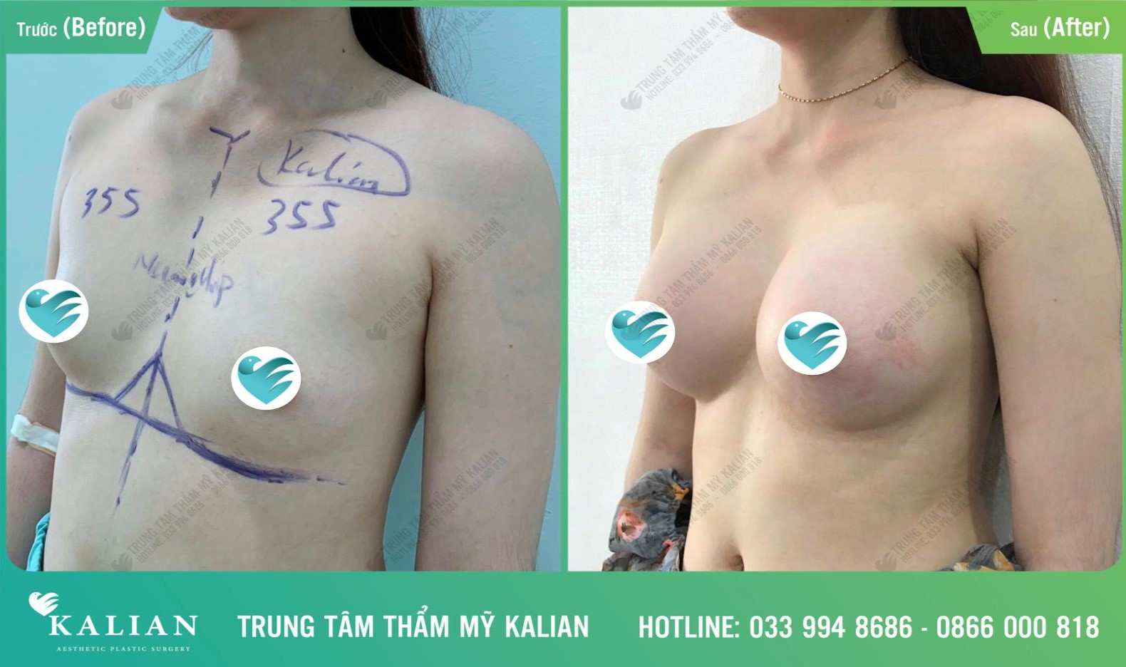 Dịch vụ nâng ngực - trung tâm thẩm mỹ Kalian