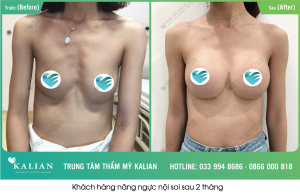 Hình ảnh trước và sau khi thực hiện nâng ngực tại Kalian 1