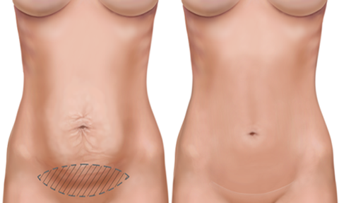 Phẫu thuật căng da bụng sau sinh
