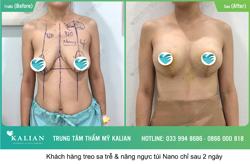 Nâng ngực chảy xệ bác sĩ Việt